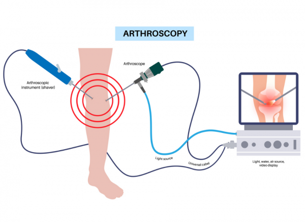 Arthroscopy of the knee showing arthroscope and screen displaying image