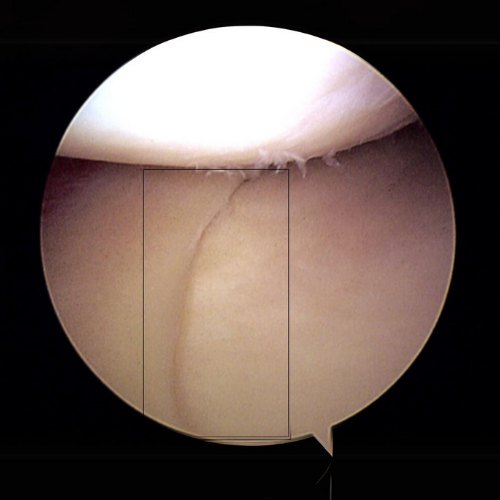 Inside of a knee showing a torn meniscus