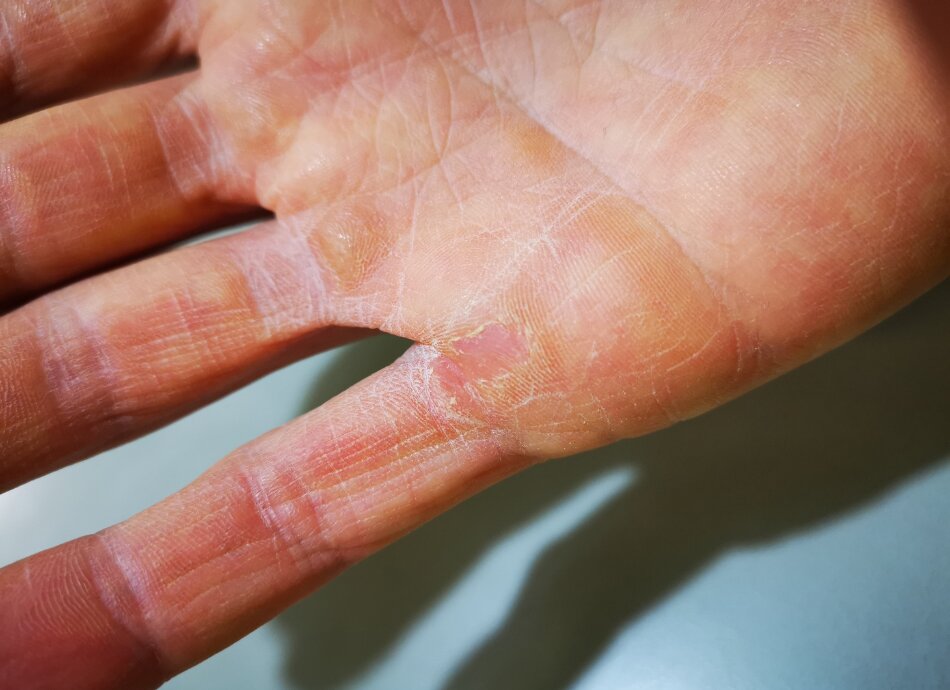 Closeup of calluses on palm of hand