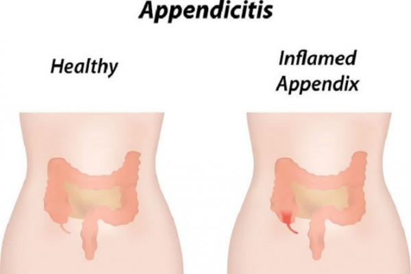 Healthy versus inflamed appendicitis graphic