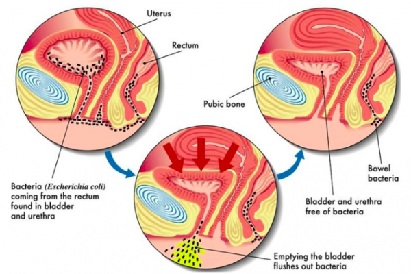 Diagram showing how bacteria can get from the rectum to the bladder causing an infection