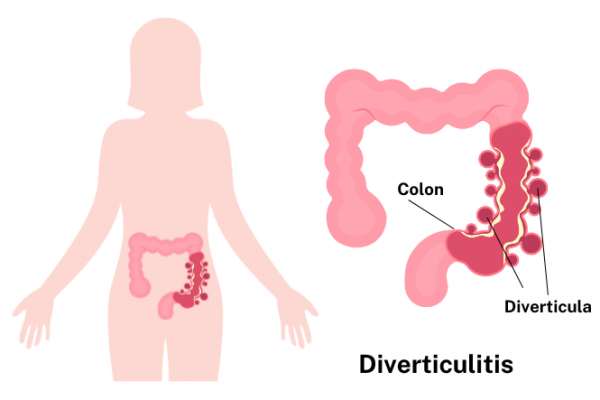 Image showing location of colon and diverticula