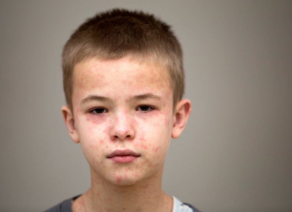 Boy's face with measles rash
