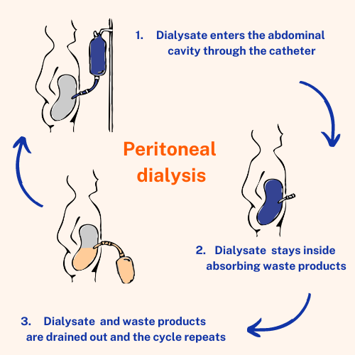 Peritoneal dialysis infographic showing different stages of introducing and draining the dialysate