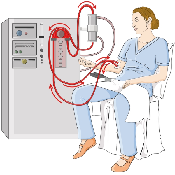 Illustration of woman having kidney dialysis
