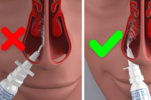 Graphic showing the correct position of the nasal spray in the nostril - tilted away from the septum