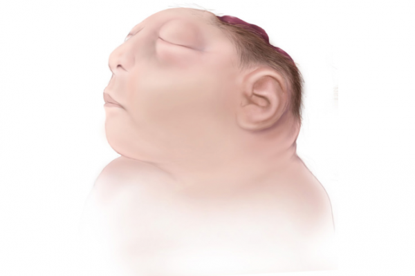 Image of baby with brain and head not fully formed due to anencephaly