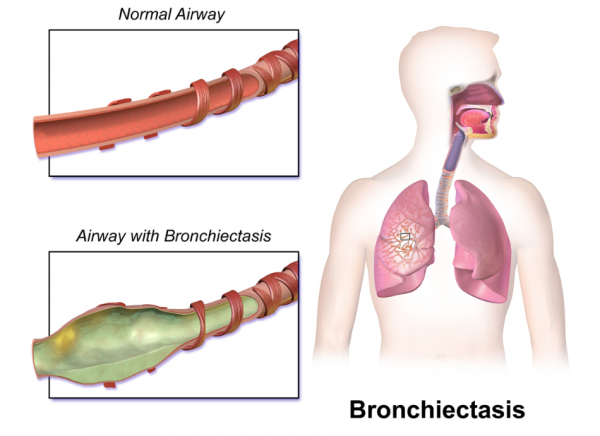 Diagram of normal airway and airway affected by bronchiectasis