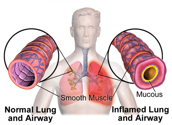 Image showing normal lung and airway and that of a person with asthma