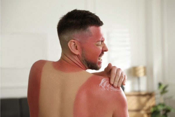 Man applying un cream to red, burned shoulder