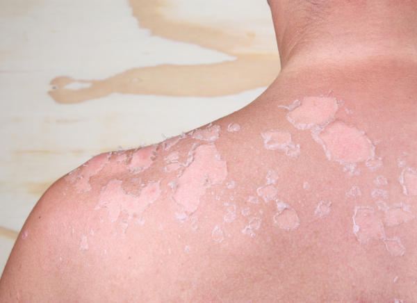 Peeling and flaking sunburnt skin on shoulder 