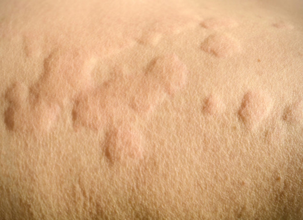 Hives on skin