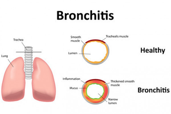 Diagram showing the trachea muscle when healthy and when thickened due to bronchitis