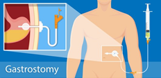 Graphic of gastrostomy tube and syringe process