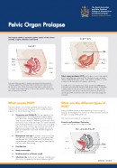 Pelvic organ prolapse brochure