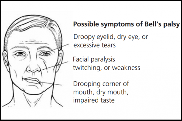 Drawing showing symptoms of Bells' palsy with droopy eye and mouth and facial paralysis