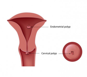 image of cervical polyp