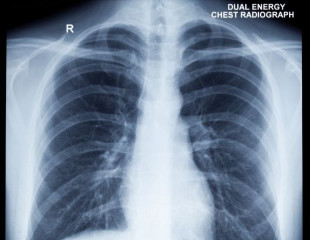 image of a chest x-ray