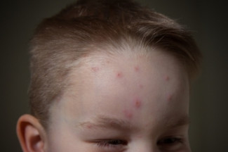 chickenpox on boy's forehead