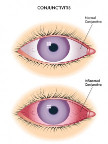 image of a normal eye and an eye with conjunctivitis