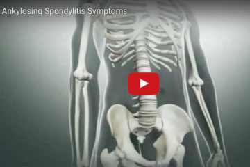 Ankylosing spondylitis – animation