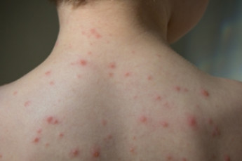 chickenpox on a boy's back