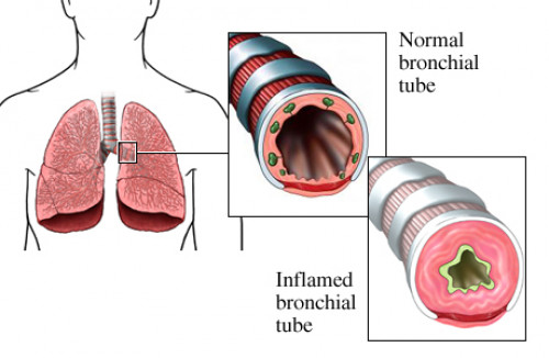 image of narrowed airways due to asthma