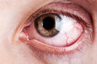 Eye infections