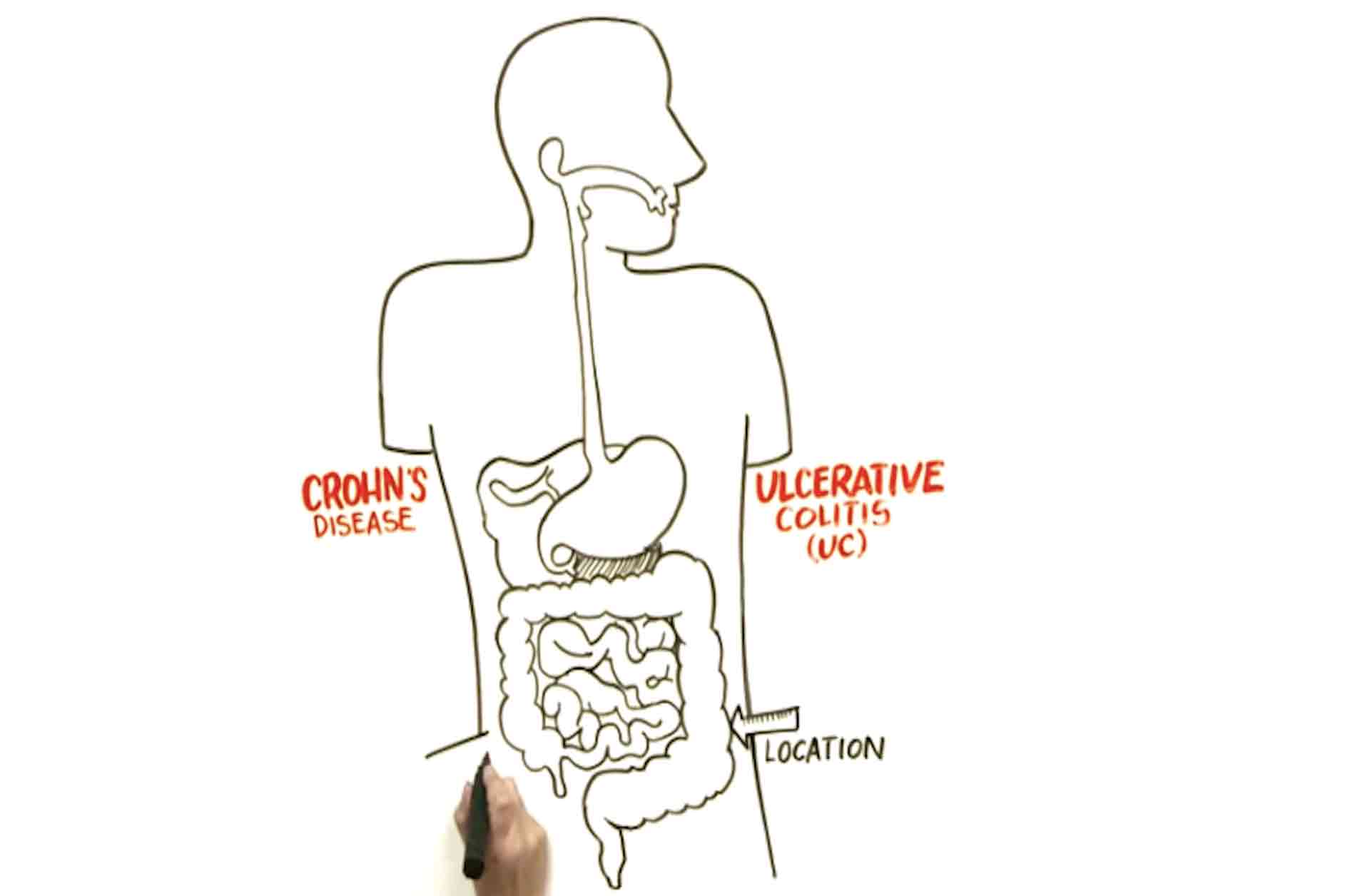 How have treatments for Crohn's disease progressed?