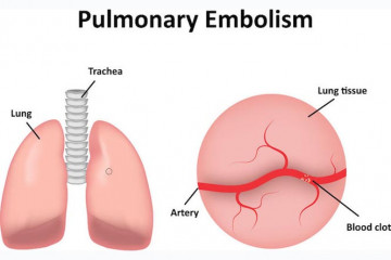 Pulmonary embolism | Pūkahukahu poketoto 