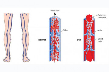Deep vein thrombosis | DVT or poketoto
