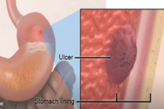 Stomach ulcer – Symptoms and treatment