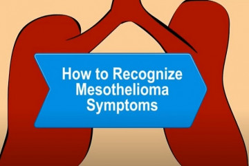 Mesothelioma – signs & symptoms
