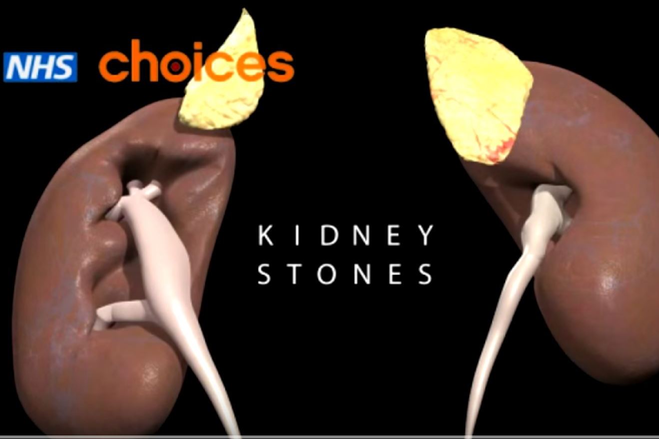 how to do keto diet kidney stones