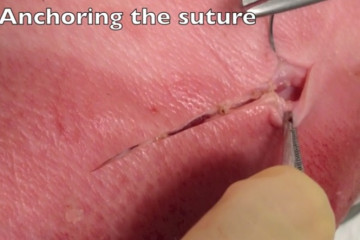 Wound closure – advanced suturing