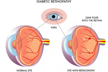 Diabetic retinopathy | Kinonga karu nā te matehuka