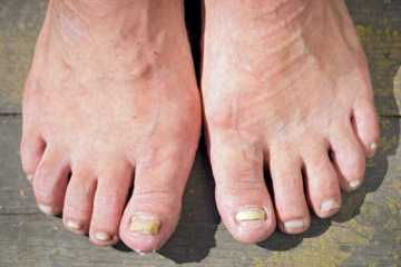 Fungal nail infections