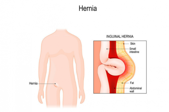 hernia-123rf-665x443.png?width=650&height=433.0075187969925