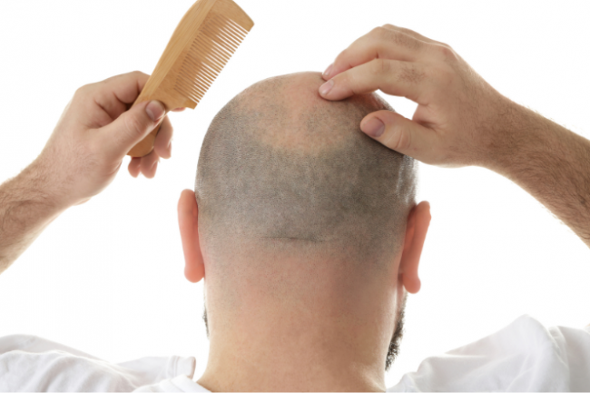 Hereditary hair loss | Health Navigator NZ