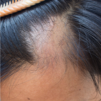 Abnormal hair loss | Health Navigator NZ