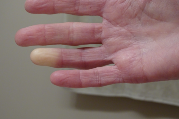 Scleroderma and systemic sclerosis (SSc)