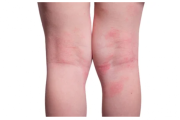 Skin infections in children