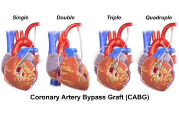 Coronary artery bypass graft surgery | Pokanga ia manawa