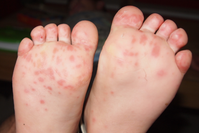 Hand, foot and mouth disease | Health Navigator NZ