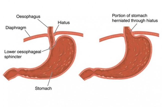 Two diagrams showing a normal stomach and one with hiatus hernnia