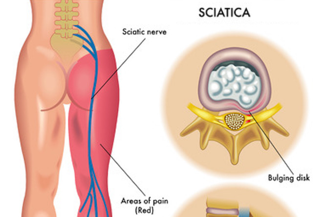 Effective sciatica for pain is tramadol
