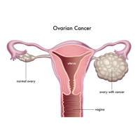 Peritoneal cancer nz, Proceduri ginecologice laparoscopice în timpul sarcinii