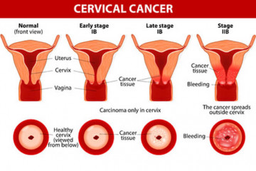 Cervical cancer | Mate pukupuku waha kōpū