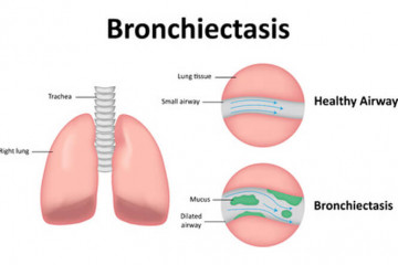 Bronchiectasis in adults | Pūkahukahu hauā