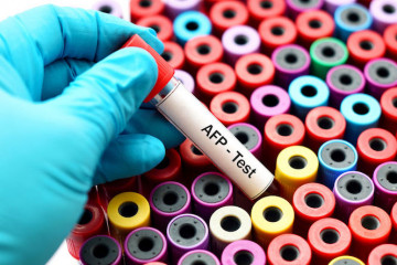 Alpha-fetoprotein (AFP) test